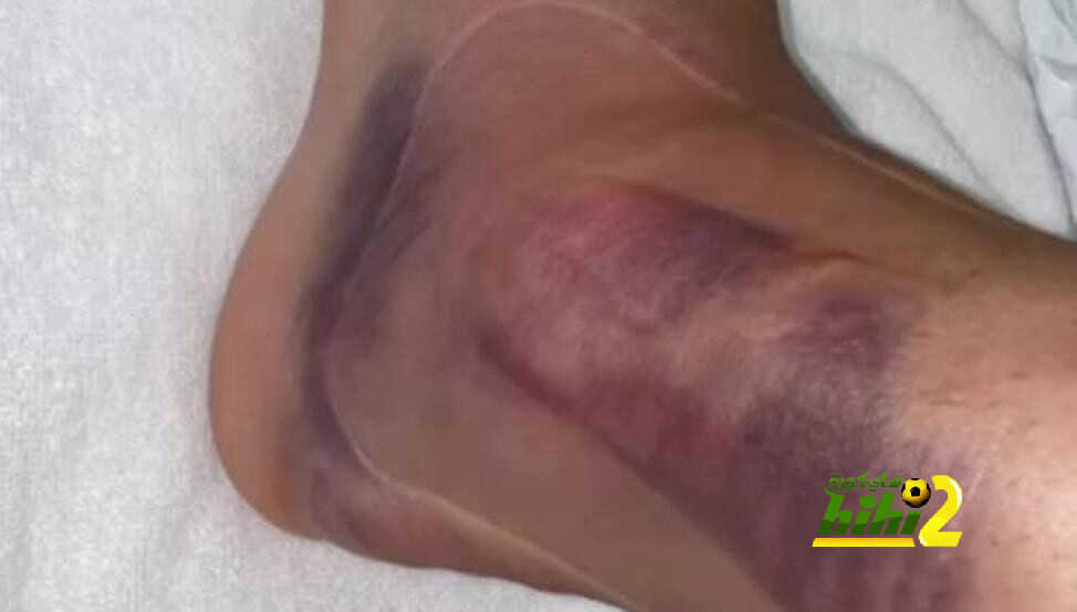 سيبايوس ينشر صورة جديدة لكاحله المصاب